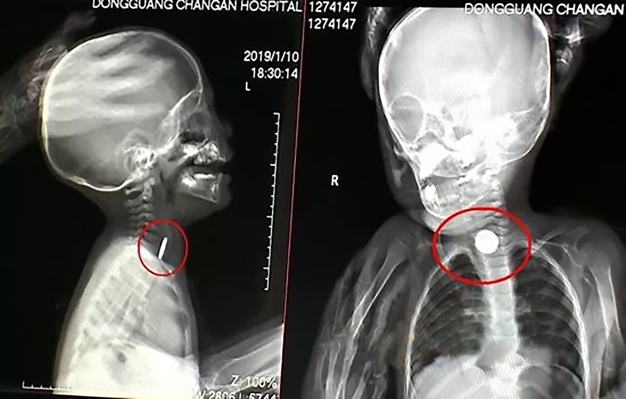 Read more about the article Unnoticed Battery In Babys Throat Was Leaking Acid