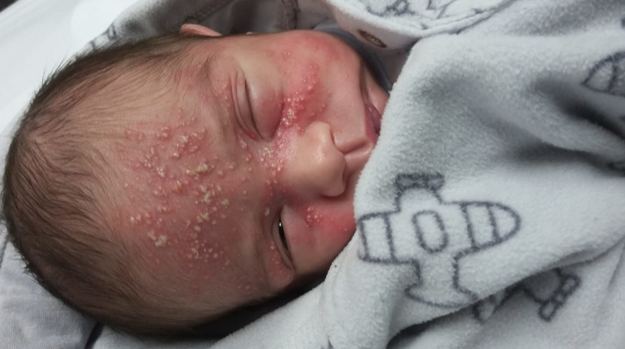 Read more about the article Warning As Newborn Infected With Herpes From Kiss