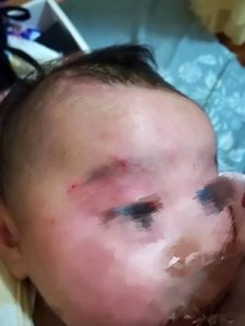 Read more about the article Sleeping Newborn Scratched And Punched By 4yo Cousin