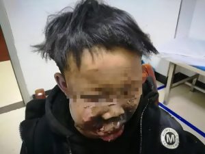 Read more about the article Boy Suffers Face Burns As Bangers Explode In His Hands