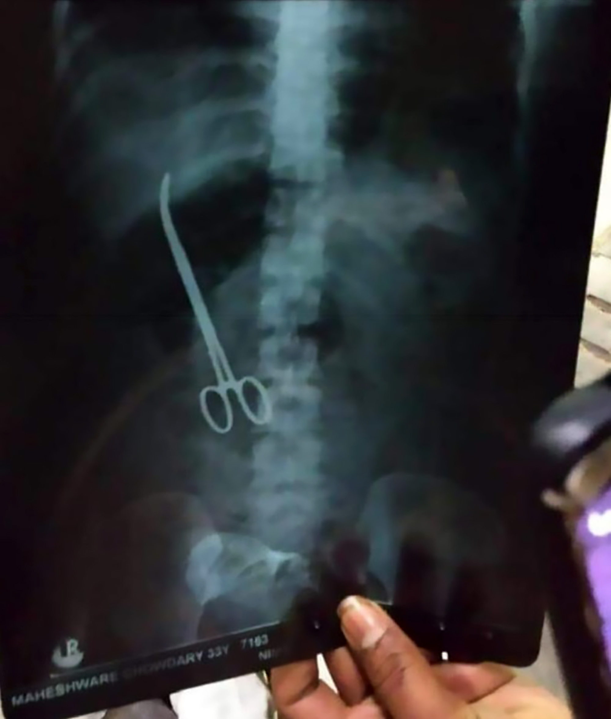 Read more about the article Medics Leave Surgical Scissors Inside Womans Stomach