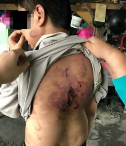 Read more about the article 12yo Boy Found With Horrific Wounds From Cable Beating