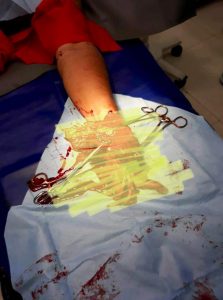 Read more about the article Mans Hand Mangled By Explosion While Charging iPhone