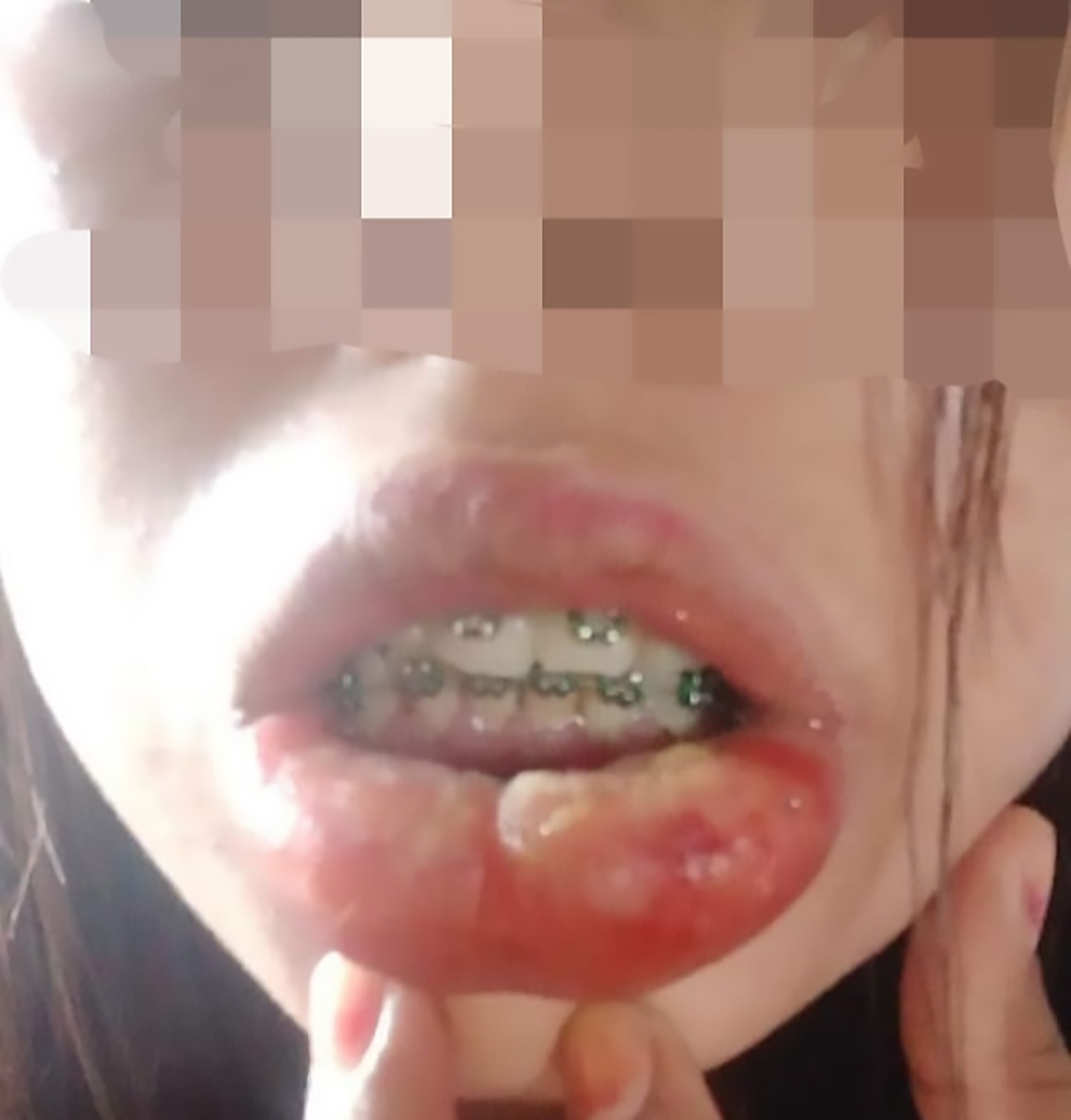 Read more about the article Bargain Braces Leave Woman With Pus-Filled Blisters
