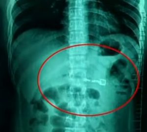 Read more about the article Medics Operate On Drunk Man To Remove Swallowed Lighter