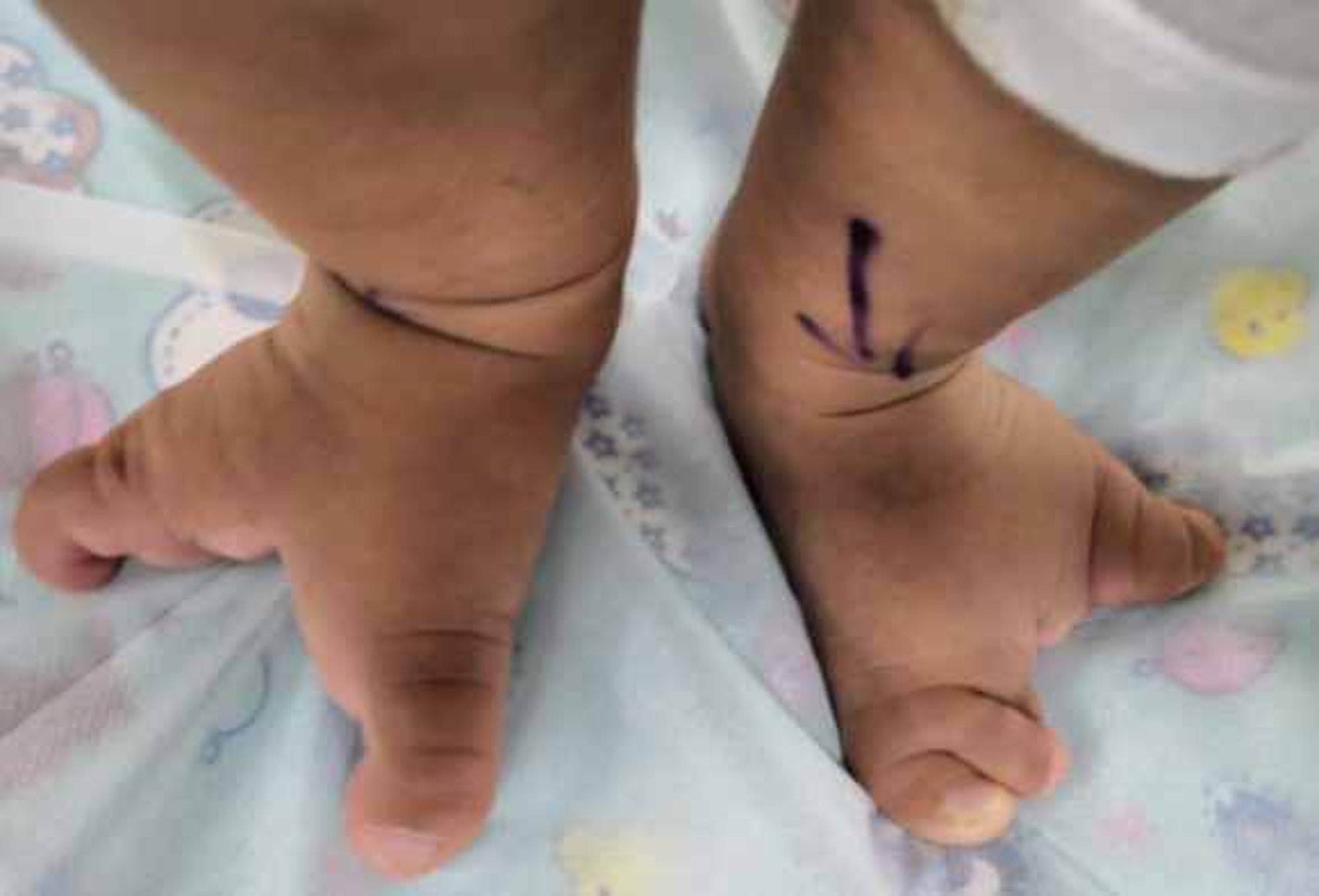Read more about the article Doc Treats Baby Girls Rare Lobster Feet Condition