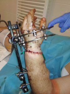 Read more about the article Doctors Reattach Man’s Hand Left Hanging On By A Thread