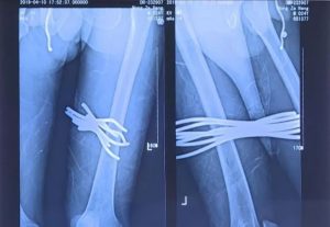 Read more about the article Builder Has Thigh Impaled By 7 Bars In Freak Accident