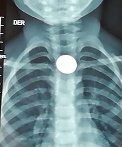 Read more about the article Mum Of 5yo Boy With Coin In Throat For 1Wk Wants Payout