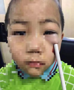 Read more about the article Hapless Tot Stabs Face With Pencil, Misses Eye By 1mm
