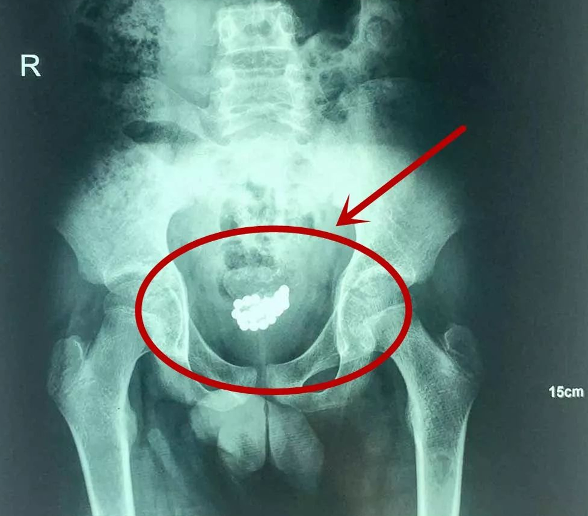 Read more about the article Teen Who Put 29 Magnetic Balls Up Penis Has Them Removed