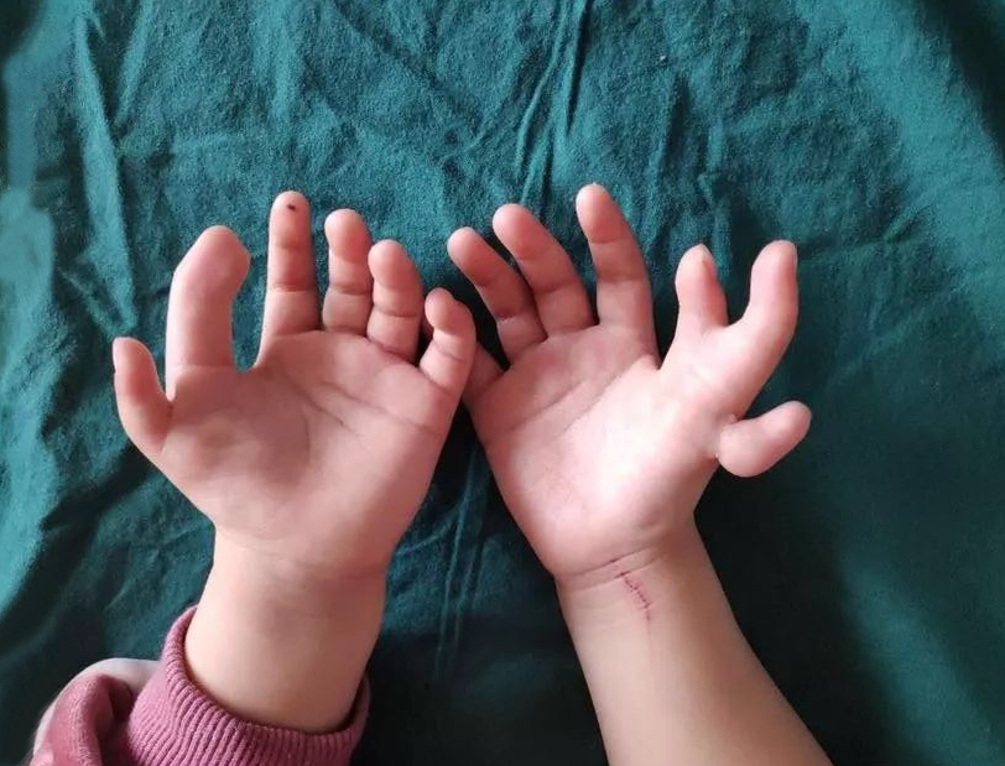 Read more about the article Little Girl, 3, With 14 Fingers Has Life-Changing Op