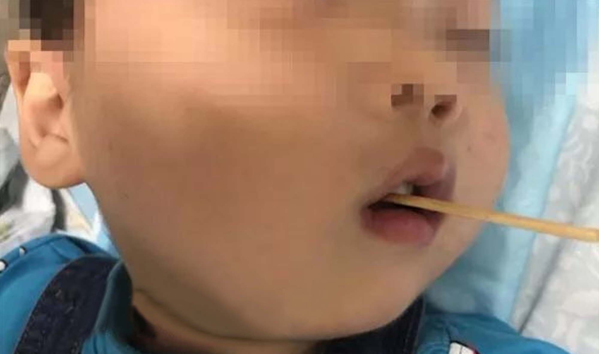 Read more about the article Boy, 3, Survives After Sausage Skewer Impales Brainstem