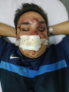 Read more about the article Football Thugs Break Journos Jaw In Brutal Beating