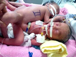 Read more about the article Doctors Baffled By These Conjoined Twins With Same Anus