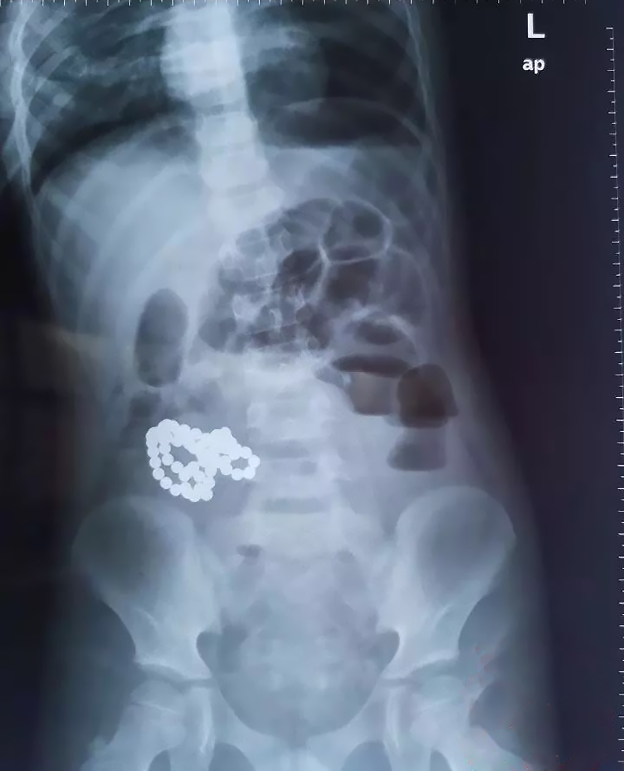 Read more about the article Docs Remove 61 Magnetic Beads From 6yo Boys Intestine