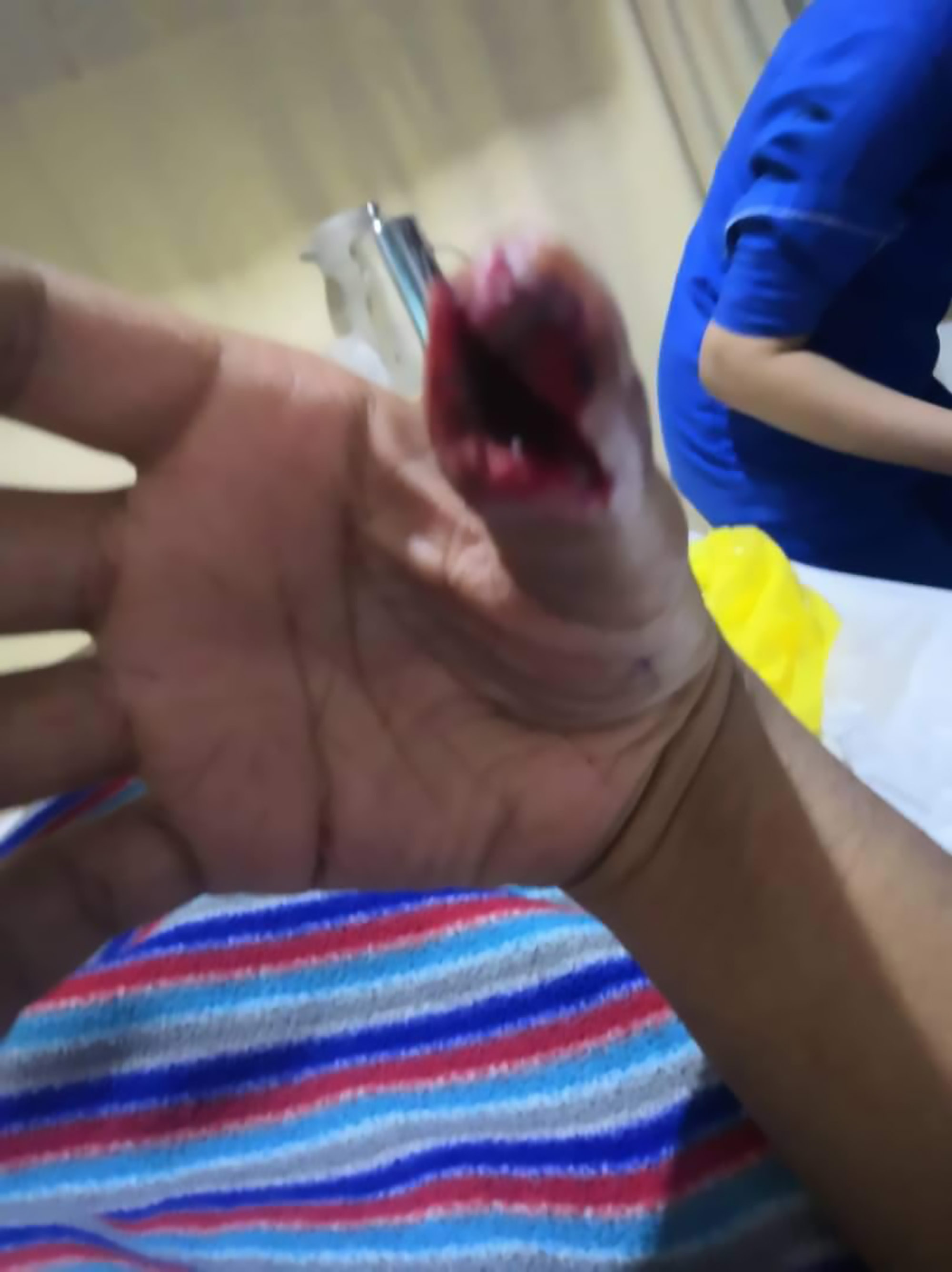 Read more about the article Phone Gamer Nearly Loses Thumb Thanks To Cracked Screen