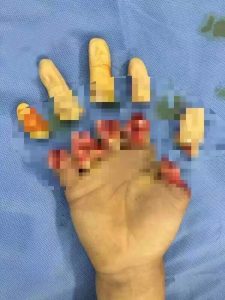 Read more about the article Factory Worker Severs 5 Fingers Before Medics Save Them