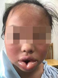 Read more about the article Peach Allergy Leaves Girl, 10, With Sausage Lips