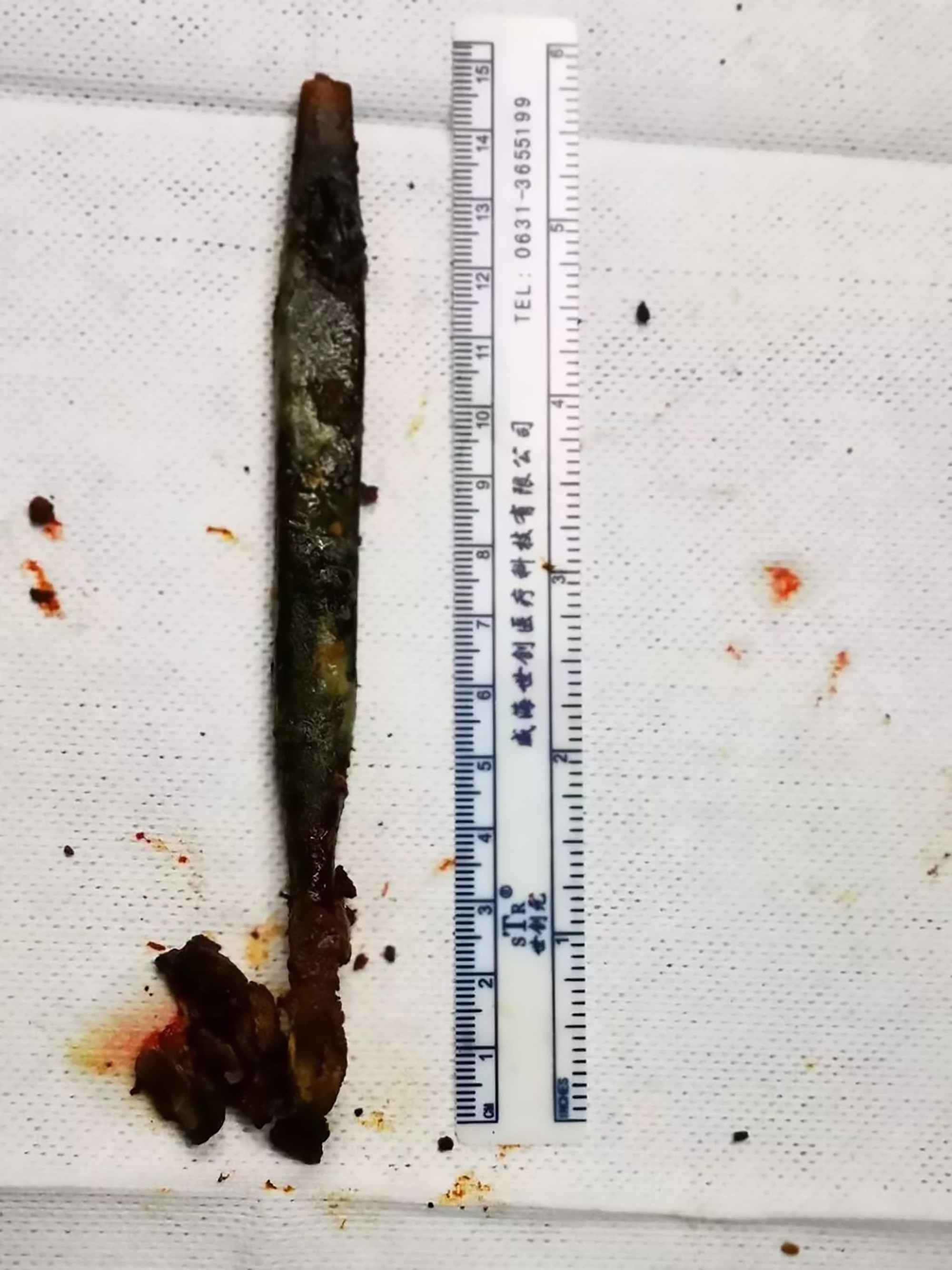 Read more about the article Toothbrush Removed From Mans Stomach After 20 Years