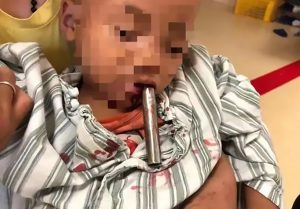 Read more about the article 10cm Metal Tube Stuck In 3yo Boy Mouth Who Fell On It