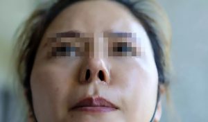 Read more about the article Botched Nose Job Leaves Woman With Avatar Film Nostrils