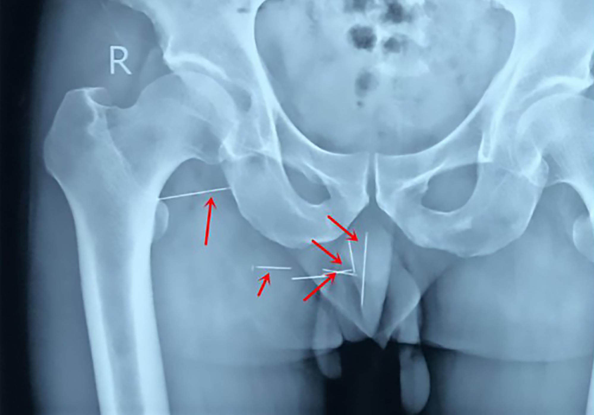 Read more about the article Man Doesnt Know 7 Needles Stuck In Bum For 10 Years