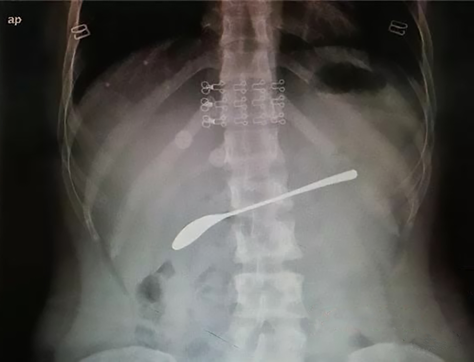 Read more about the article Drs Remove 6-Inch Spoon From Drunk Womans Stomach