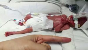 Read more about the article Newborn Baby Size Of A Hand Weighs Just 1 lb