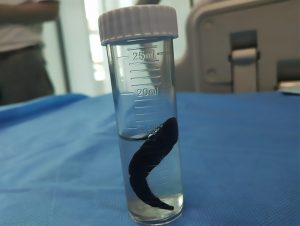 Read more about the article Fat 3-Inch Leech Found Wriggling In 8yo Boys Throat
