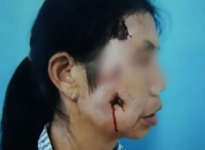 Read more about the article 3-Inch Twig Stuck In Womans Face 2 Yrs After Tree Crash