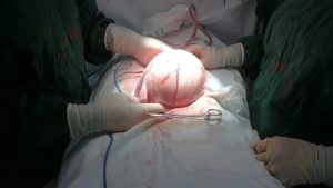Read more about the article Woman Who Looked Pregnant Had Melon-Sized Tumour