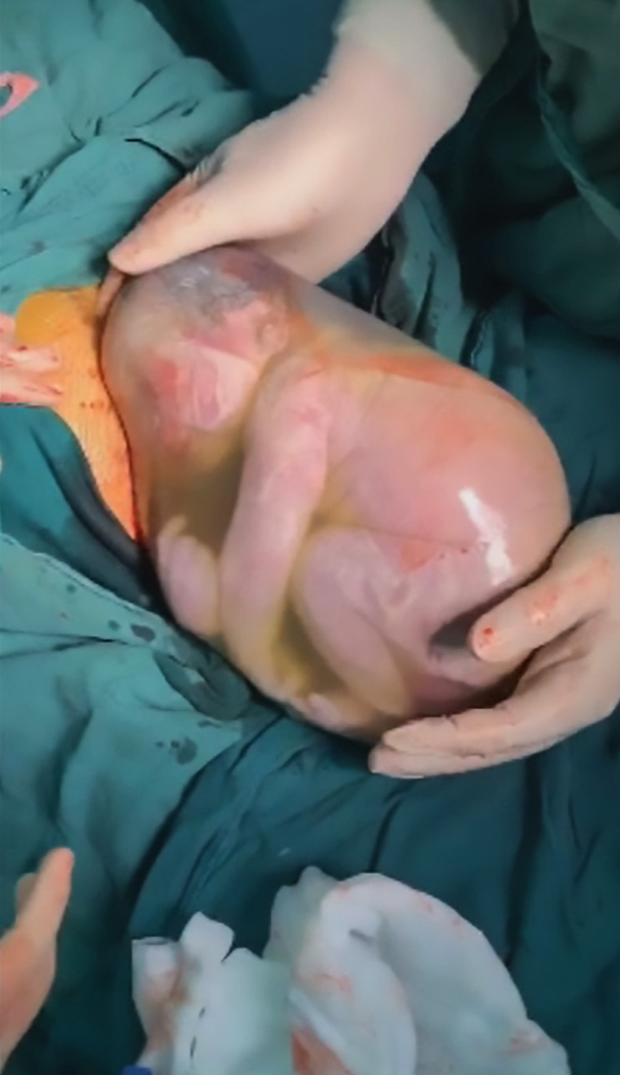Read more about the article Bubble Boy Born At 36 Weeks Floats In Amniotic Sac