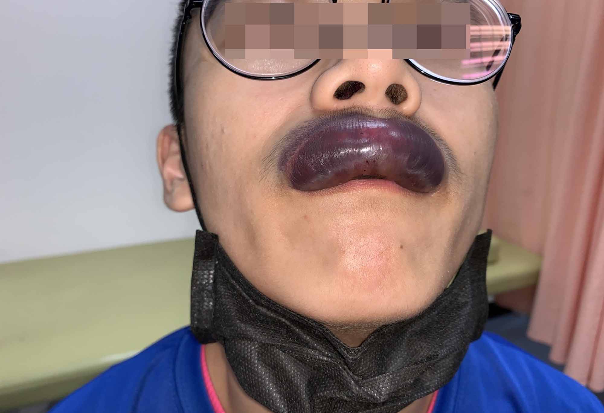Read more about the article Student Left With Sausage Lip After Sports Clash
