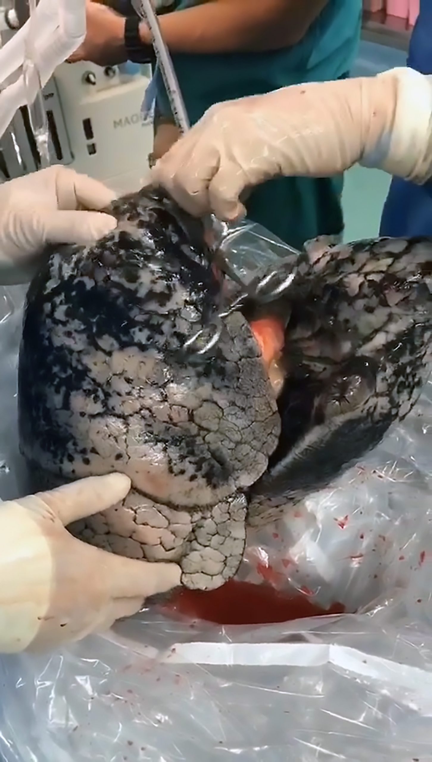 Read more about the article Dr Rejects Blackened Lungs Donated By 30y Chain Smoker