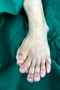 Read more about the article Man With 9 Toes On Foot Has Extras Removed After 21 Yrs