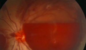 Read more about the article Woman Burst Eye Blood Vessel With Excessive Phone Usage