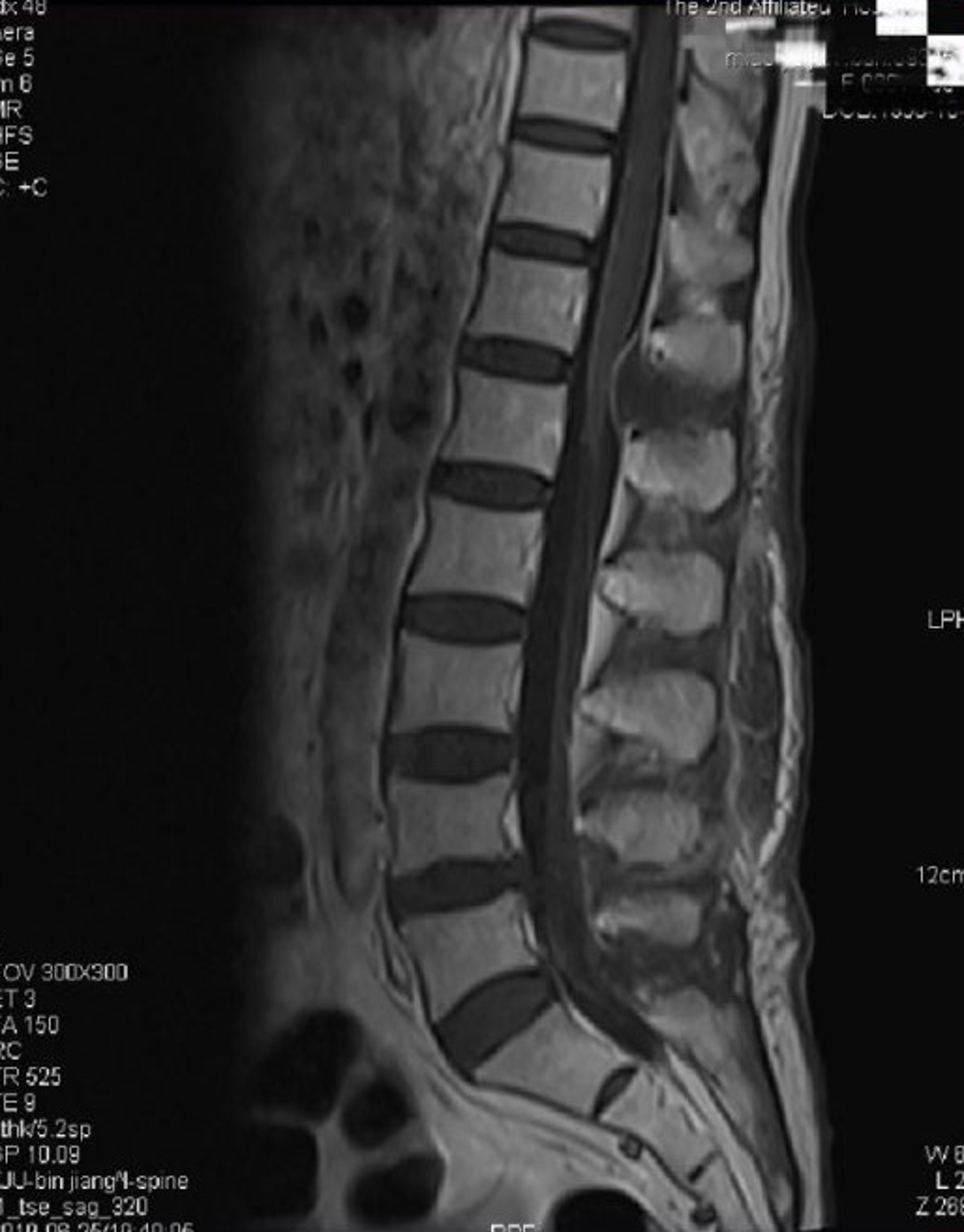 Read more about the article Doctors Remove String Of Tumours Growing Inside Spine