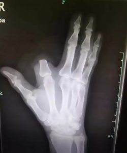 Read more about the article Bungling Man Needlessly Cuts Off Finger After Snake Bite