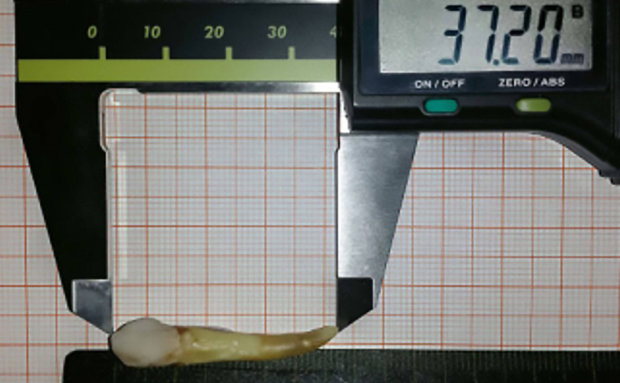 Read more about the article Guiness World Record As Longest Human Tooth Extracted
