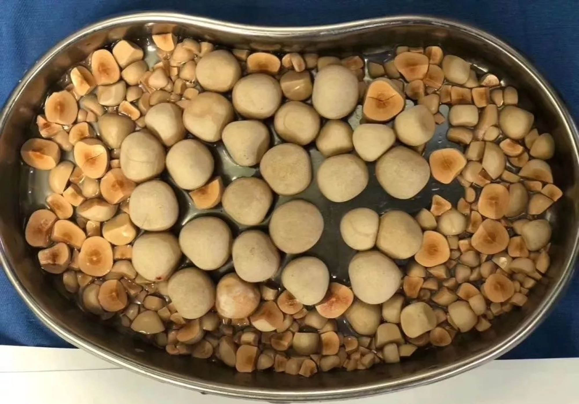 Read more about the article Shock Images As 100 Stones Removed From 83yo OAP Bladder