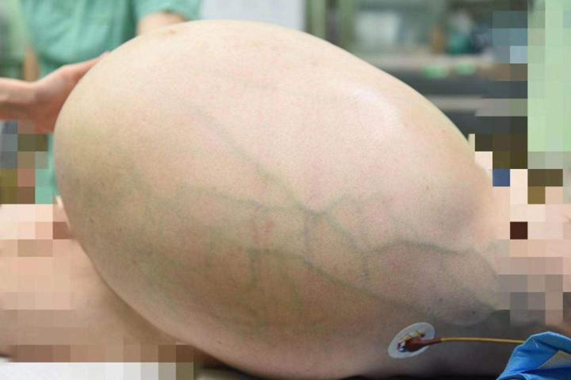 Read more about the article Womans 77lb Tumour Made Her Look Preggers With Triplets