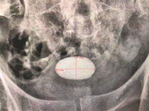 Read more about the article 5-Year-Old Bladder Stone Grows Into Size Of Egg