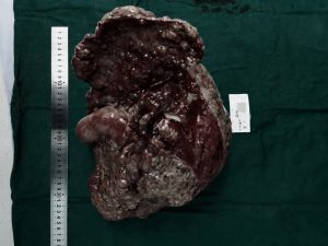 Read more about the article Doctors Remove Diseased 12lb Liver From Cancer Patient