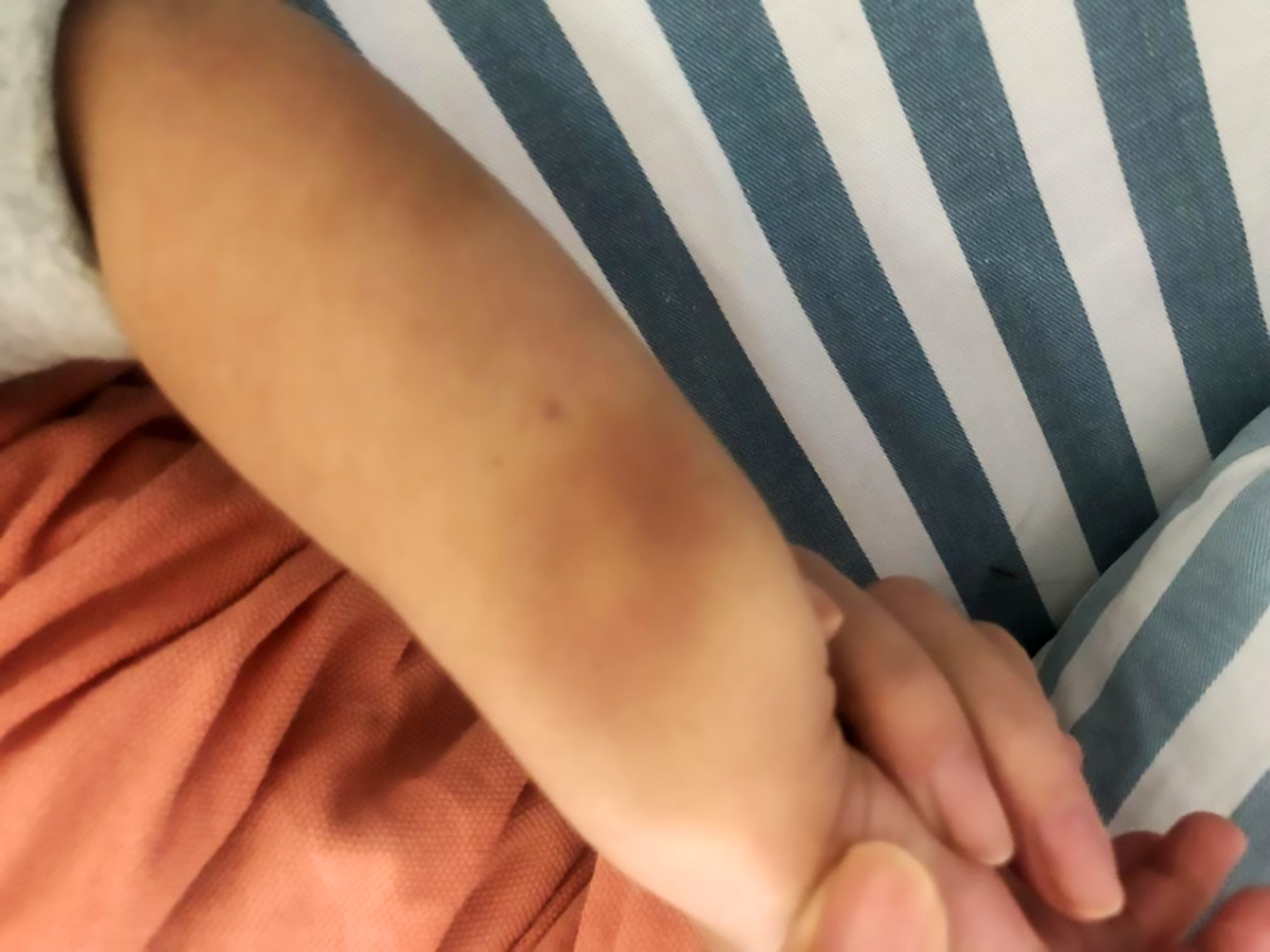 Read more about the article Bruised Toddler Has Tapeworm Parasites Living Under Skin