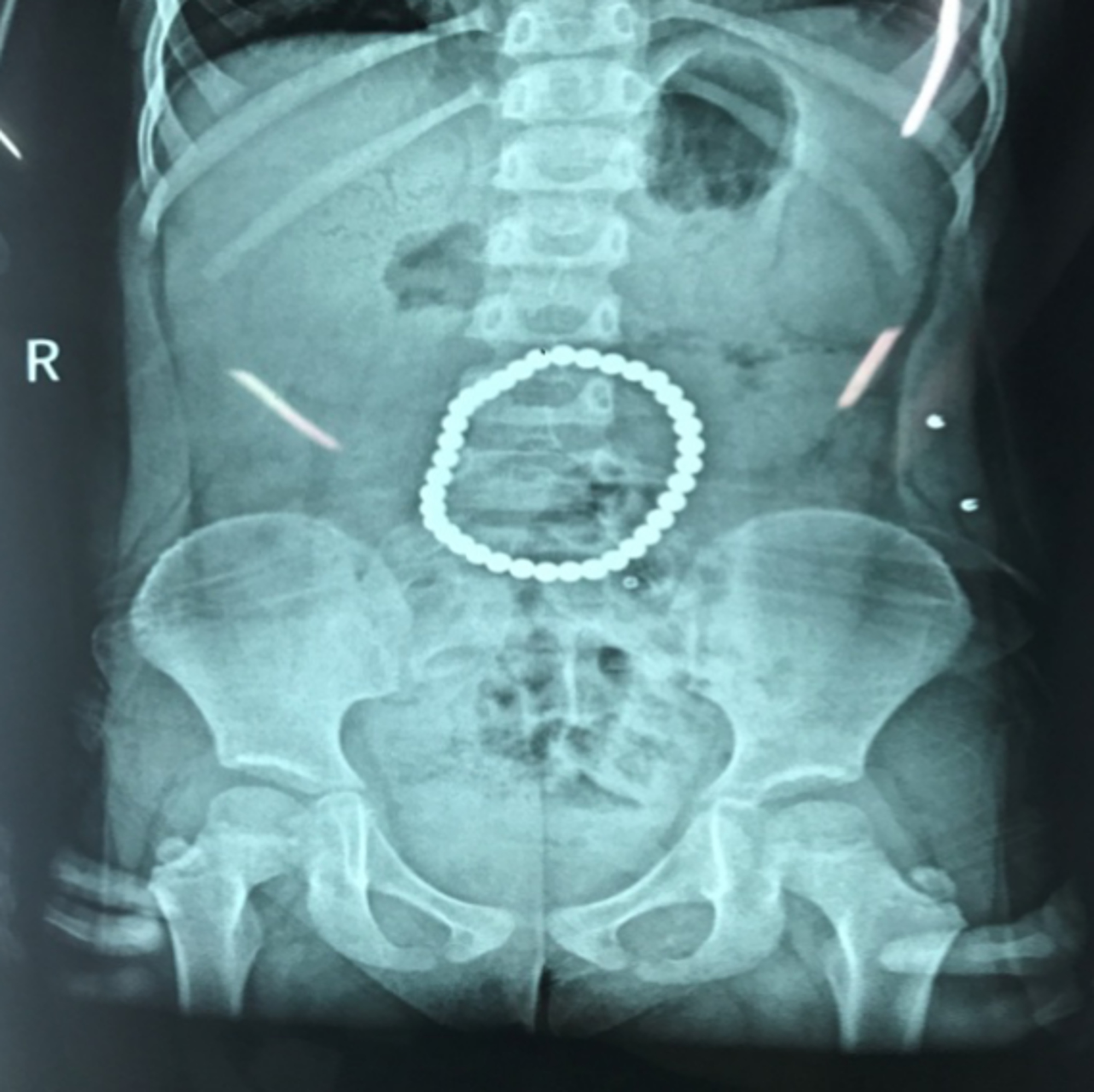 Read more about the article Tot Eating 37 Magnetic Balls Rips 5 Holes In Stomach