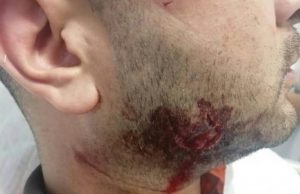 Read more about the article Spain Metro Guard Bitten All Over Face By Clubber