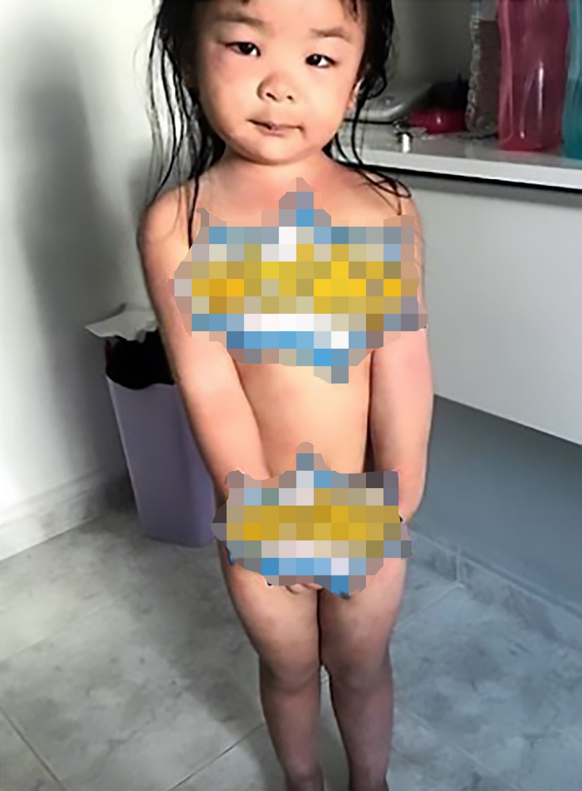 Read more about the article Little Girl Suffers Horror Burns From Swim Pool Chlorine