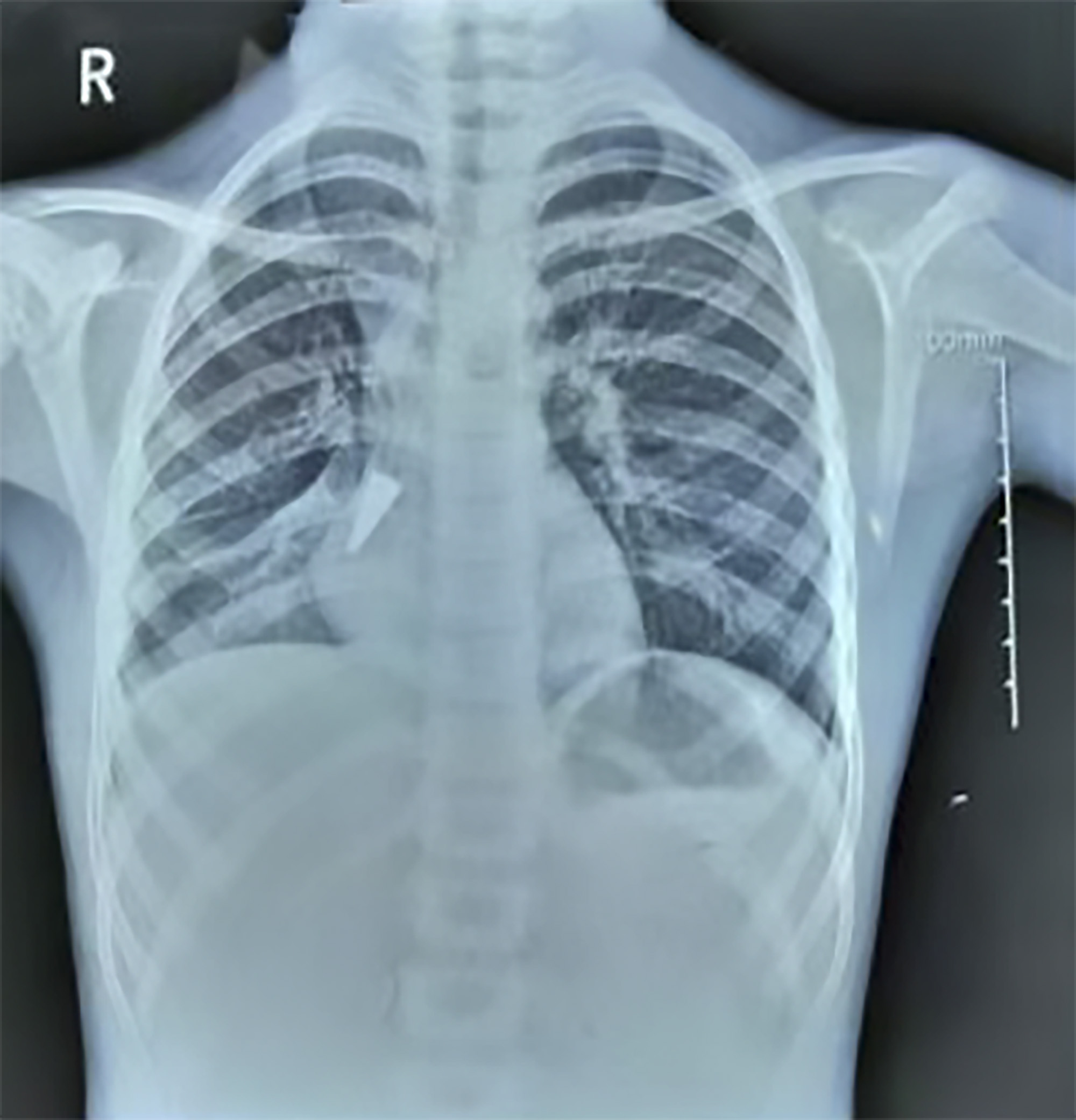 Read more about the article Drs Find Metal Pen Cap In 7yo Girls Lung After 3w Cough
