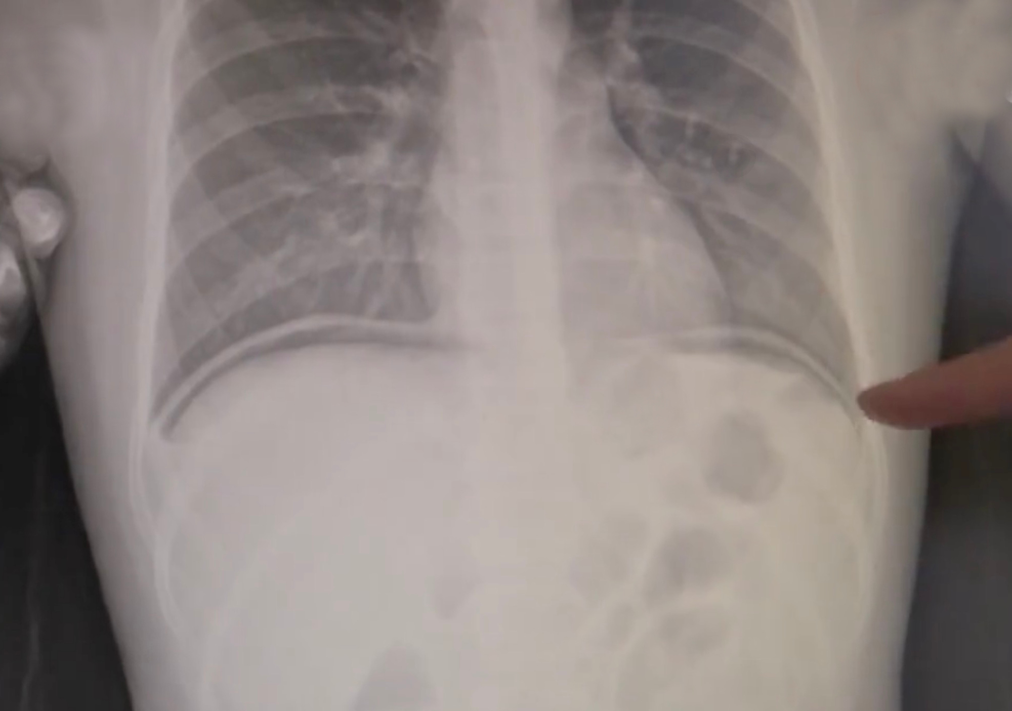 Read more about the article X-Rays: Boy Falls In Shower And Rams Brush Handle Up Bum